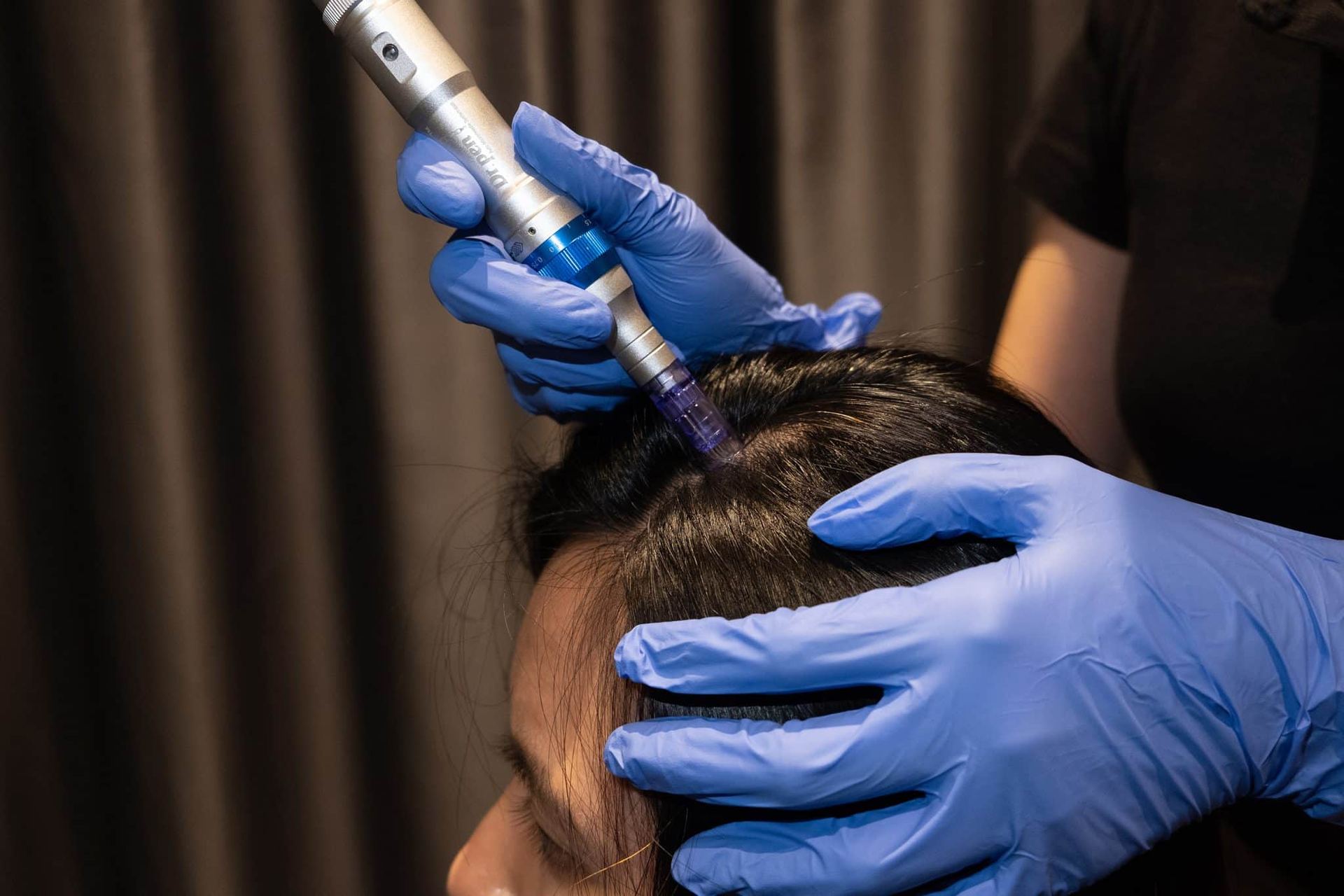 Microneedling capilar realizado por médico en Juvenalia Brío